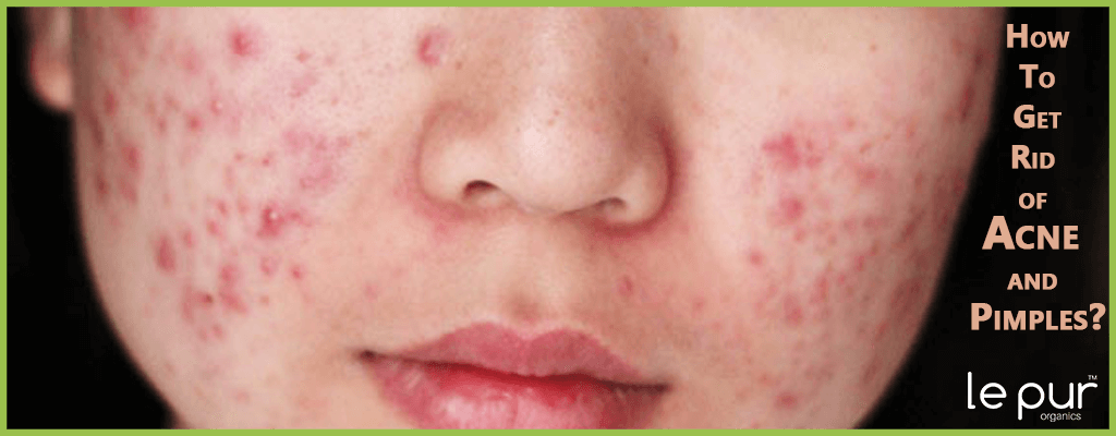 How to get rid of pimples and acne in just 10 days